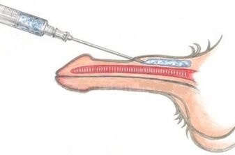 A dangerous method to enlarge the penis with vaseline injection